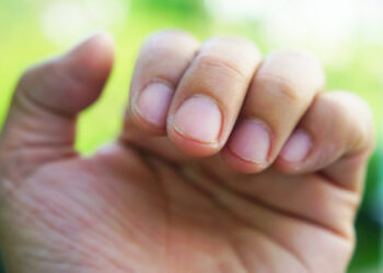 Κορωνοϊός: Πέντε σημάδια στα νύχια που δείχνουν ότι περάσατε την Covid-19