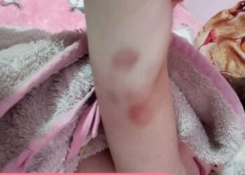 Θάνατος τριών παιδιών στην Πάτρα: Φωτογραφία – ντοκουμέντο με μελανιές στο χέρι της Τζωρτζίνας