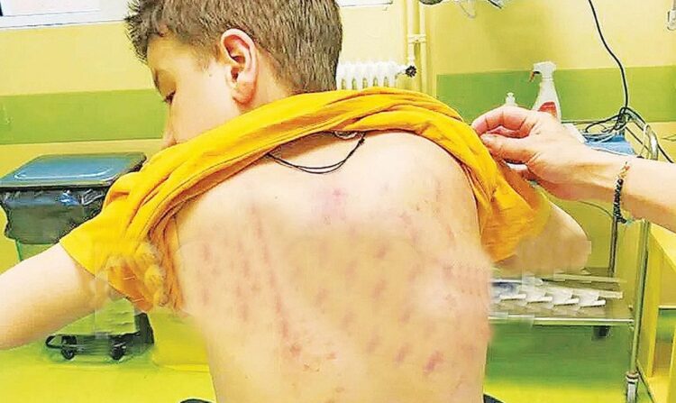 Σάπισαν στο ξύλο μαθητή ΑμεΑ – Η μήνυση και η δίωξη συμμαθητών