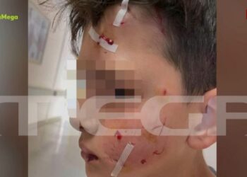 Λαγονήσι: Σκύλος επιτέθηκε και κατασπάραξε 13χρονο καθώς πήγαινε σχολείο – Με βαθιά τραύματα στο πρόσωπο το παιδί