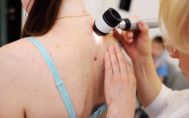 Έρευνα: Εμβόλιο των Moderna και Merck κατά του καρκίνου του δέρματος – Μειώνει κατά 44% τον κίνδυνο υποτροπής ή θανάτου