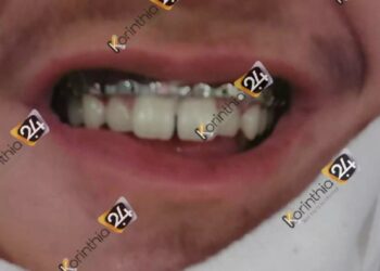 Λουτράκι: Σοκάρουν οι εικόνες του μαθητή ΕΠΑΛ που έπεσε θύμα άγριου ξυλοδαρμού – Κατάγματα στην κάτω γνάθο