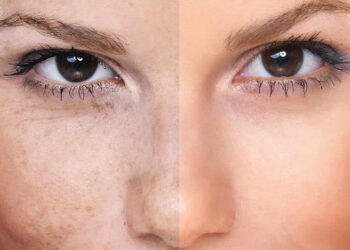 Πανάδες: Tι είναι και πώς να απαλλαγείς