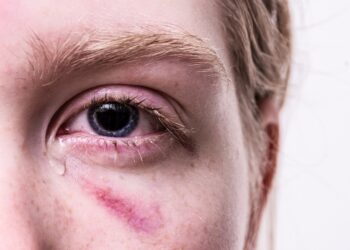 Φρίκη: 37χρονη κάλεσε 24χρονη και την κλείδωσε σε κλουβί για σκύλους και την περιέλουσε με βραστό νερό