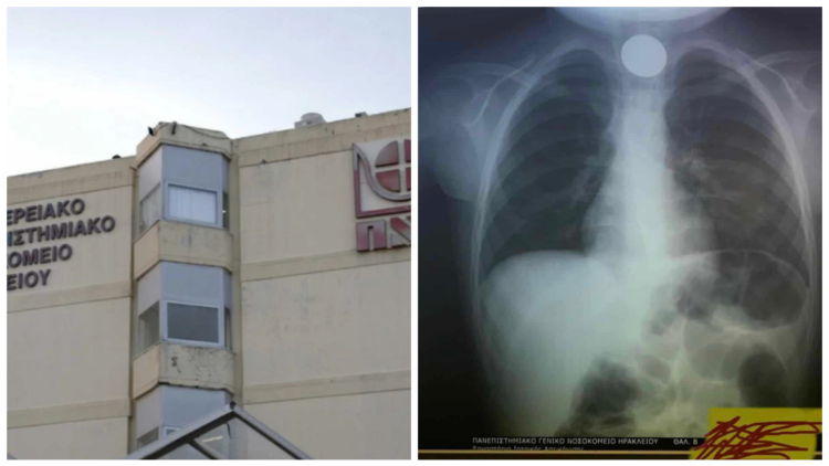 Σώθnκε από θαúμα: Κέρμα σφηνώθnκε στον λαıμό 4χρоνоυ στην Κρήτη ανήμερα Πρωτοχρονιάς