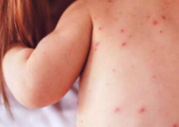 Η ιλαρά είναι η πιο μολυσματική ασθένεια που έχει γνωρίσει η επιστήμη: Η σημασία του εμβολιασμού παιδιών και ενηλίκων