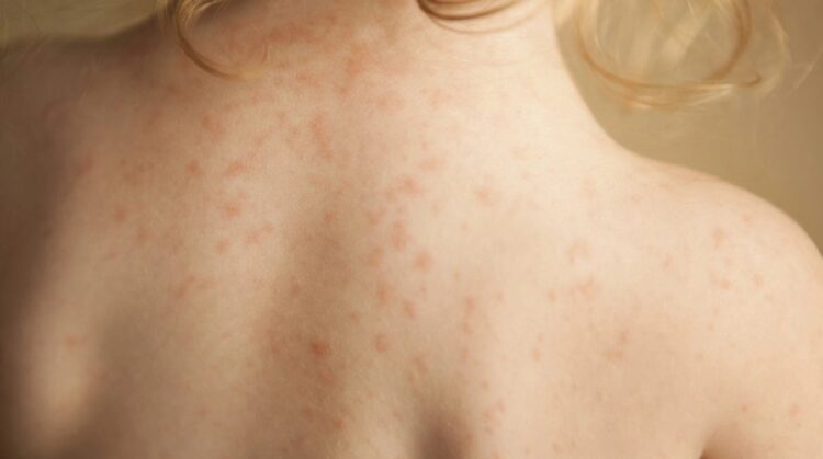 Φοιτήτρια από το Πανεπιστήμιο Πάτρας το νέο κρούσμα μηνιγγίτιδας