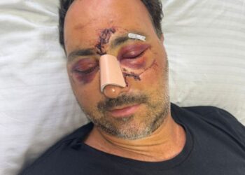 Άγριος ξυλοδαρμός Ελληνοκαναδού χρηματιστή για μια παρατήρηση – Ήρθε διακοπές στην Ελλάδα και του έκαναν 60 ράμματα στο κεφάλι